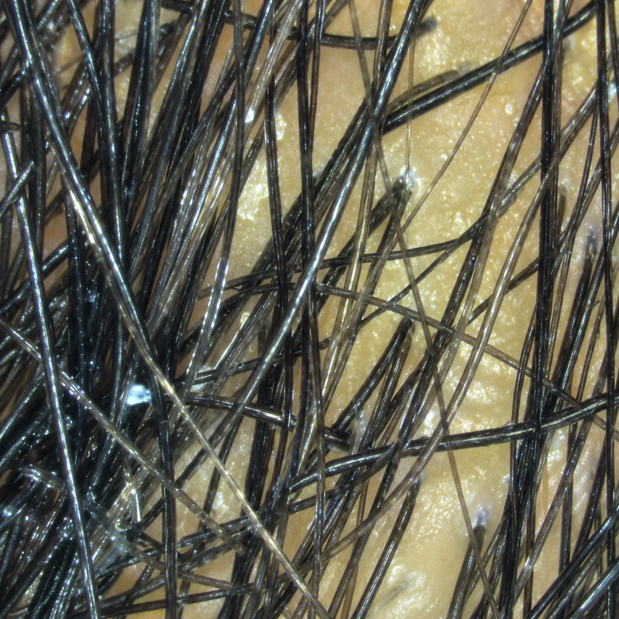Before and after hair restoration treatment showing significant density improvement